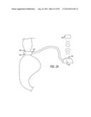 METHOD FOR INCREASING DISTENSIBILITY IN A GASTRIC BAND diagram and image