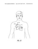 METHOD FOR INCREASING DISTENSIBILITY IN A GASTRIC BAND diagram and image