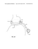 METHOD FOR INCREASING DISTENSIBILITY IN A GASTRIC BAND diagram and image