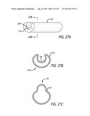 METHOD FOR INCREASING DISTENSIBILITY IN A GASTRIC BAND diagram and image