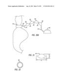 METHOD FOR INCREASING DISTENSIBILITY IN A GASTRIC BAND diagram and image