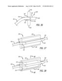 METHOD FOR INCREASING DISTENSIBILITY IN A GASTRIC BAND diagram and image