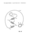 METHOD FOR INCREASING DISTENSIBILITY IN A GASTRIC BAND diagram and image