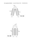 METHOD FOR INCREASING DISTENSIBILITY IN A GASTRIC BAND diagram and image