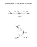 METHOD FOR INCREASING DISTENSIBILITY IN A GASTRIC BAND diagram and image