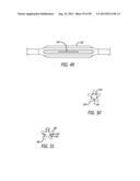 METHOD FOR INCREASING DISTENSIBILITY IN A GASTRIC BAND diagram and image