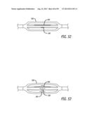 METHOD FOR INCREASING DISTENSIBILITY IN A GASTRIC BAND diagram and image