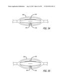 METHOD FOR INCREASING DISTENSIBILITY IN A GASTRIC BAND diagram and image