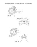 METHOD FOR INCREASING DISTENSIBILITY IN A GASTRIC BAND diagram and image