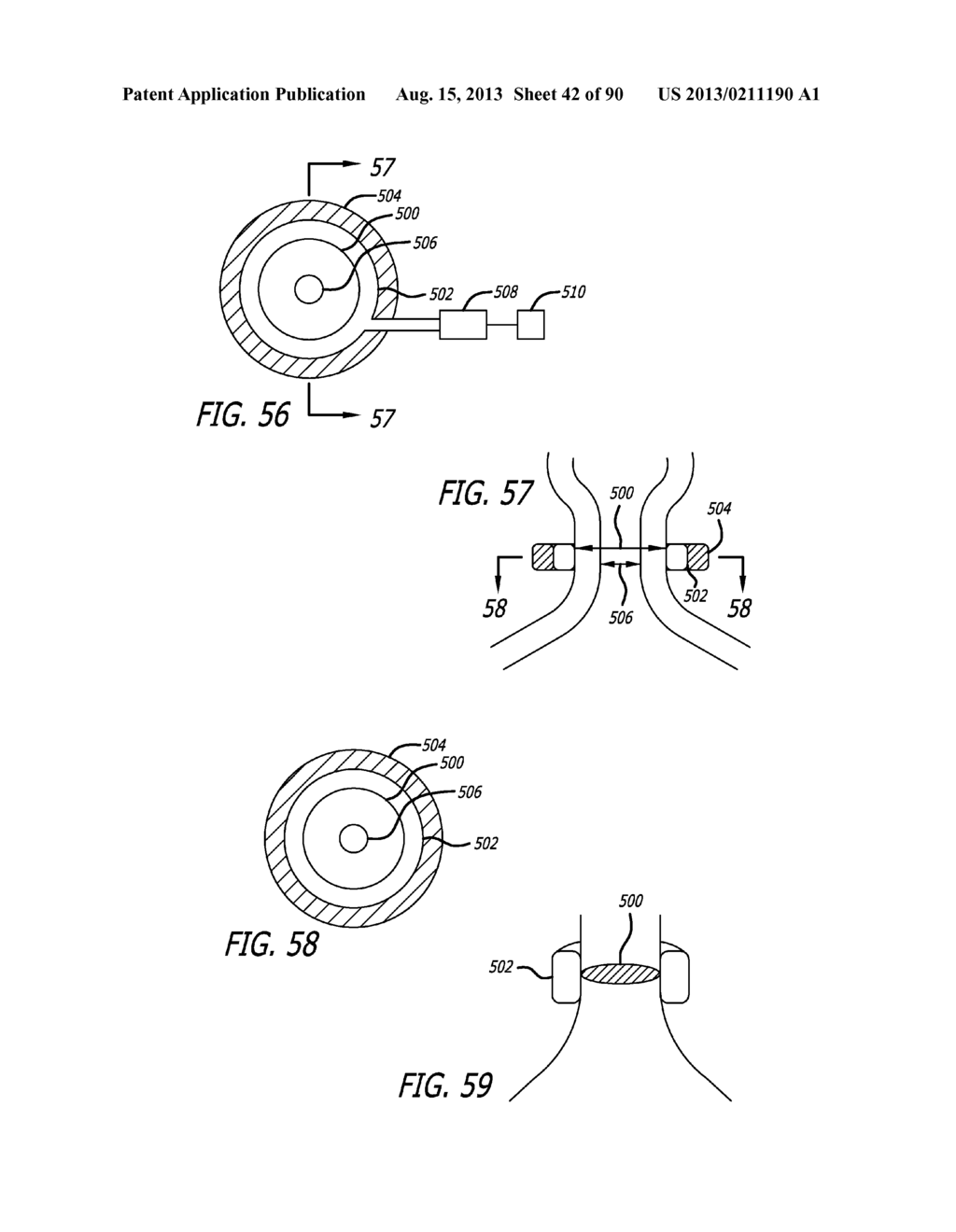 METHOD FOR INCREASING DISTENSIBILITY IN A GASTRIC BAND - diagram, schematic, and image 43