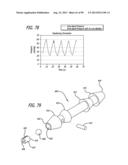 METHOD FOR INCREASING DISTENSIBILITY IN A GASTRIC BAND diagram and image