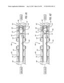 METHOD FOR INCREASING DISTENSIBILITY IN A GASTRIC BAND diagram and image