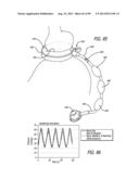 METHOD FOR INCREASING DISTENSIBILITY IN A GASTRIC BAND diagram and image