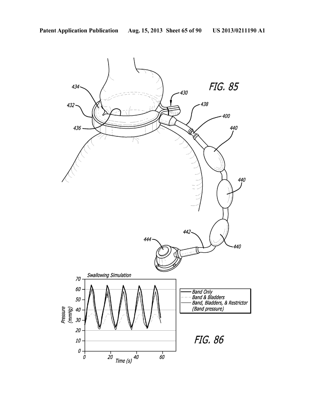 METHOD FOR INCREASING DISTENSIBILITY IN A GASTRIC BAND - diagram, schematic, and image 66