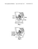 APPARATUS FOR POSTERIOR PELVIC FLOOR REPAIR diagram and image