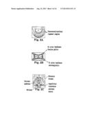 APPARATUS FOR POSTERIOR PELVIC FLOOR REPAIR diagram and image