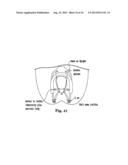 APPARATUS FOR POSTERIOR PELVIC FLOOR REPAIR diagram and image