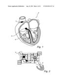 Device, A Kit And A Method For Treatment Of Disorders In The Heart Rhythm     Regulation System diagram and image