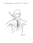 Device, A Kit And A Method For Treatment Of Disorders In The Heart Rhythm     Regulation System diagram and image