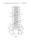 VERTEBRAL IMPLANT AND CONNECTOR diagram and image