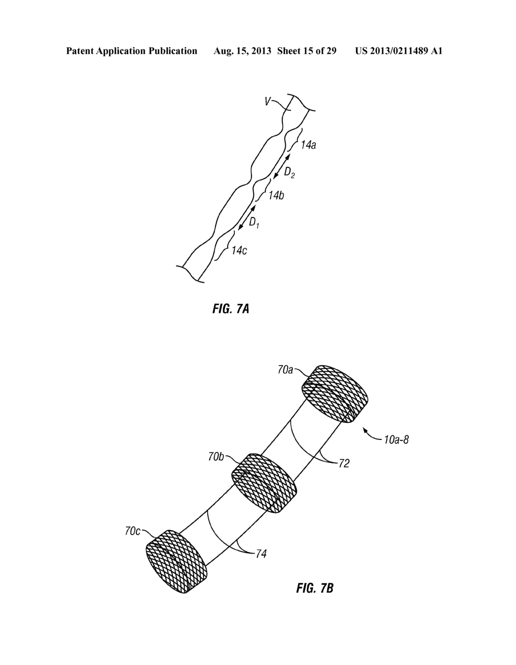 Methods, Systems and Devices for Treatment of Cerebrospinal Venous     Insufficiency and Multiple Sclerosis - diagram, schematic, and image 16