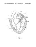 SEQUENTIALLY DEPLOYED TRANSCATHETER MITRAL VALVE PROSTHESIS diagram and image