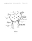 SEQUENTIALLY DEPLOYED TRANSCATHETER MITRAL VALVE PROSTHESIS diagram and image