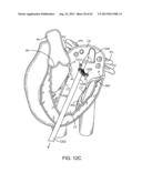 SEQUENTIALLY DEPLOYED TRANSCATHETER MITRAL VALVE PROSTHESIS diagram and image