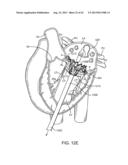 SEQUENTIALLY DEPLOYED TRANSCATHETER MITRAL VALVE PROSTHESIS diagram and image