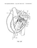 SEQUENTIALLY DEPLOYED TRANSCATHETER MITRAL VALVE PROSTHESIS diagram and image