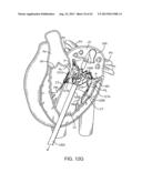 SEQUENTIALLY DEPLOYED TRANSCATHETER MITRAL VALVE PROSTHESIS diagram and image