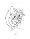 SEQUENTIALLY DEPLOYED TRANSCATHETER MITRAL VALVE PROSTHESIS diagram and image