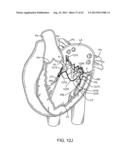 SEQUENTIALLY DEPLOYED TRANSCATHETER MITRAL VALVE PROSTHESIS diagram and image