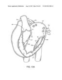 SEQUENTIALLY DEPLOYED TRANSCATHETER MITRAL VALVE PROSTHESIS diagram and image