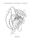 SEQUENTIALLY DEPLOYED TRANSCATHETER MITRAL VALVE PROSTHESIS diagram and image