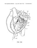 SEQUENTIALLY DEPLOYED TRANSCATHETER MITRAL VALVE PROSTHESIS diagram and image