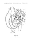 SEQUENTIALLY DEPLOYED TRANSCATHETER MITRAL VALVE PROSTHESIS diagram and image