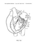 SEQUENTIALLY DEPLOYED TRANSCATHETER MITRAL VALVE PROSTHESIS diagram and image