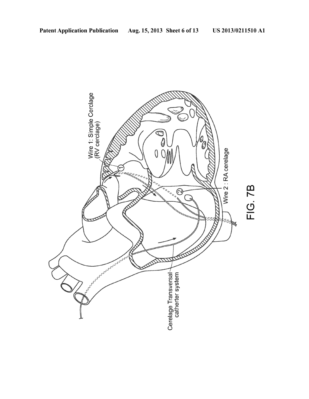 METHODS AND DEVICES FOR TRANSCATHETER CERCLAGE ANNULOPLASTY - diagram, schematic, and image 07