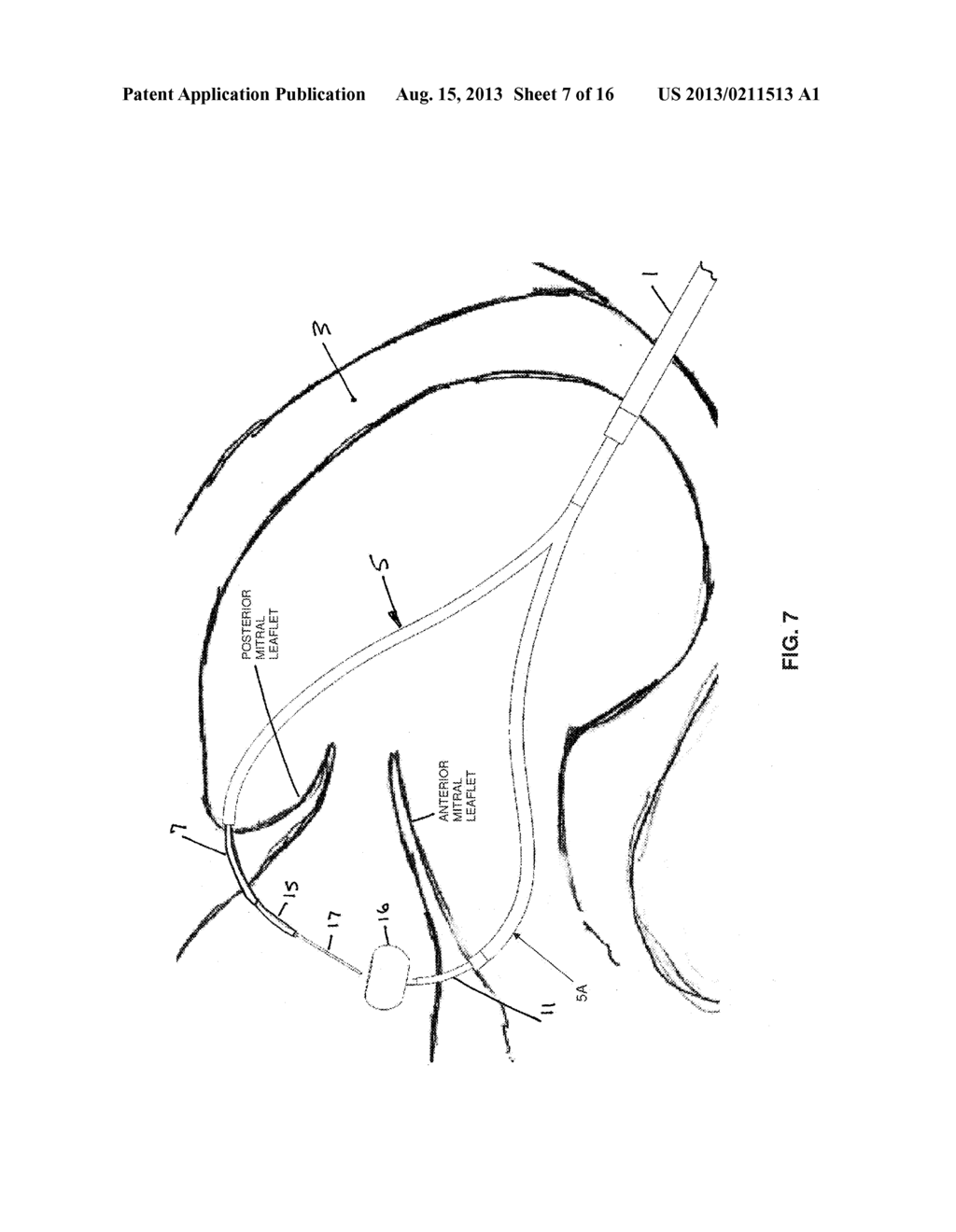 METHOD AND APPARATUS FOR REPAIRING A MITRAL VALVE - diagram, schematic, and image 08