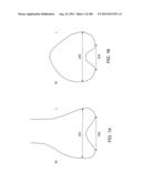 PATIENT-ADAPTED AND IMPROVED ARTICULAR IMPLANTS, DESIGNS AND RELATED GUIDE     TOOLS diagram and image