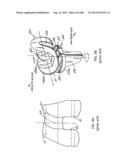 PATIENT-ADAPTED AND IMPROVED ARTICULAR IMPLANTS, DESIGNS AND RELATED GUIDE     TOOLS diagram and image