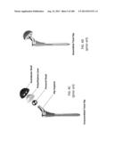 PATIENT-ADAPTED AND IMPROVED ARTICULAR IMPLANTS, DESIGNS AND RELATED GUIDE     TOOLS diagram and image