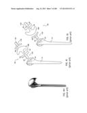 PATIENT-ADAPTED AND IMPROVED ARTICULAR IMPLANTS, DESIGNS AND RELATED GUIDE     TOOLS diagram and image