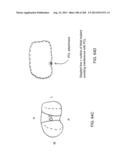 PATIENT-ADAPTED AND IMPROVED ARTICULAR IMPLANTS, DESIGNS AND RELATED GUIDE     TOOLS diagram and image