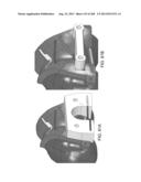 PATIENT-ADAPTED AND IMPROVED ARTICULAR IMPLANTS, DESIGNS AND RELATED GUIDE     TOOLS diagram and image