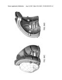 PATIENT-ADAPTED AND IMPROVED ARTICULAR IMPLANTS, DESIGNS AND RELATED GUIDE     TOOLS diagram and image