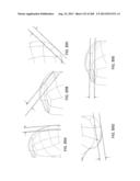 PATIENT-ADAPTED AND IMPROVED ARTICULAR IMPLANTS, DESIGNS AND RELATED GUIDE     TOOLS diagram and image