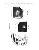 PATIENT-ADAPTED AND IMPROVED ARTICULAR IMPLANTS, DESIGNS AND RELATED GUIDE     TOOLS diagram and image