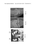 PATIENT-ADAPTED AND IMPROVED ARTICULAR IMPLANTS, DESIGNS AND RELATED GUIDE     TOOLS diagram and image